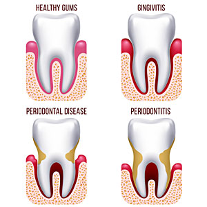 progression of gum disease