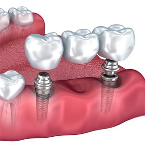 two dental implants supporting a dental bridge